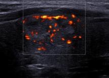 Lipome intramusculaire et Liposarcome bien différencié Lipome intramusculaire et Liposarcome bien différencié