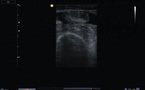 Rupture Complète du Tendon Distal du Droit Antérieur