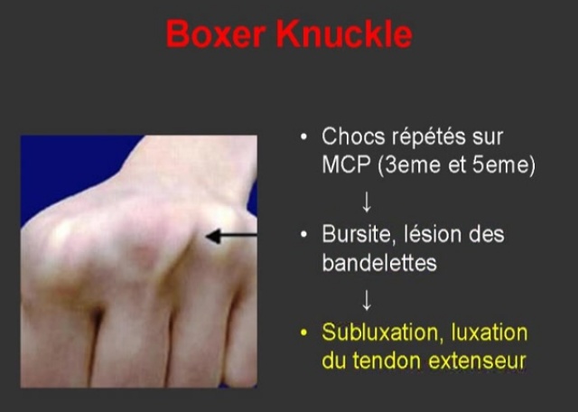 Boxer Knuckle