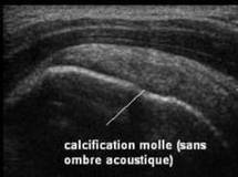 Aspect échographique des calcifications