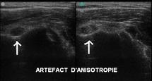 Artéfact d’anisotropie