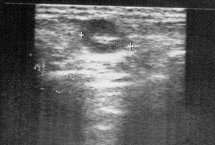 Echographie d’un ganglion Echographie d’un ganglion