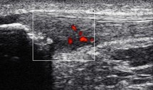 Tendinopathie : MTP, Ondes de Choc ou pas ? Tendinopathie : MTP, Ondes de Choc ou pas ?