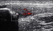 Tendinopathie : MTP, Ondes de Choc ou pas ?