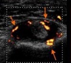 Ténosynovite du long biceps