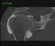 Les limites de l’arthroscanner de l’épaule Les limites de l’arthroscanner de l’épaule