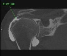 Les limites de l’arthroscanner de l’épaule