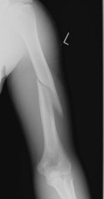 Muskuloskeletal  Radiology  of  Fractures