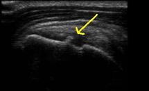 Caractériser une calcification