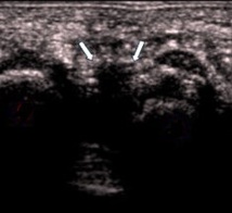 Nevrome de Morton Nevrome de Morton
