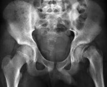 Epiphysiolyse Fémorale Supérieure (2) Epiphysiolyse Fémorale Supérieure (2)