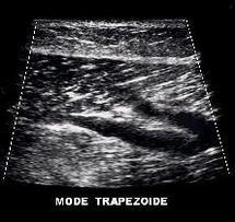 Imagerie trapezoïdale Imagerie trapezoïdale