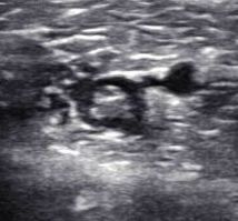 Traumatisme musculaire de la jambe Traumatisme musculaire de la jambe