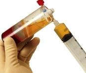 Injection de PRP sous échoguidage dans les traumatismes musculaires Injection de PRP sous échoguidage dans les traumatismes musculaires