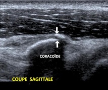 Fracture de l'apophyse coracoïde
