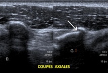 Fracture de l'apophyse coracoïde