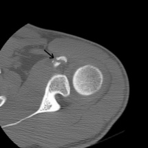 Fracture de l'apophyse coracoïde