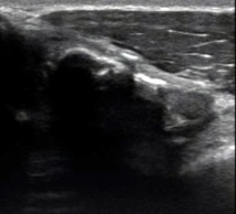 Fracture du sternum Fracture du sternum