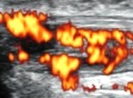 Apport du doppler couleur en ostéoarticulaire