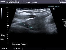 Comment infiltrer sous échoguidage l'enthèse distale du biceps brachial ?