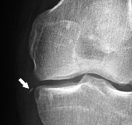 Fracture de Segond Fracture de Segond