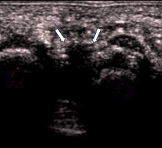Nevrome de Morton Nevrome de Morton