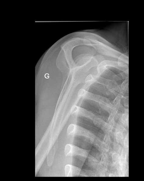 Fracture de l'apophyse coracoïde