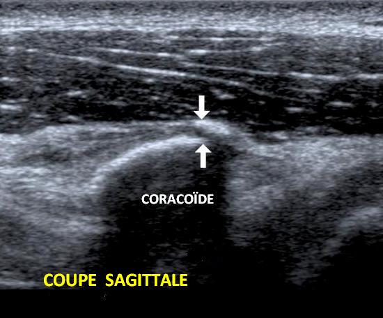 Fracture de l'apophyse coracoïde