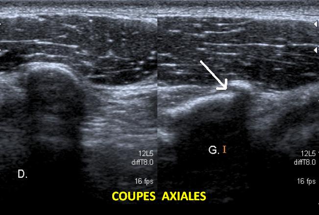 Fracture de l'apophyse coracoïde