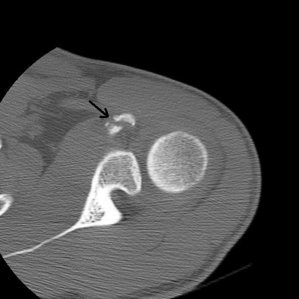 Fracture de l'apophyse coracoïde