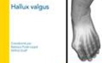 Hallux Valgus