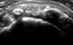 Volumineuse calcification du tendon supra-épineux