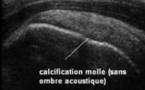 Aspect échographique des calcifications