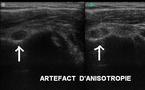 Artéfact d’anisotropie