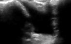 Syndrome du sinus du tarse