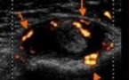 Ténosynovite du long biceps