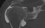 Les limites de l’arthroscanner de l’épaule