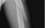 Muskuloskeletal  Radiology  of  Fractures