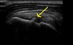 Caractériser une calcification