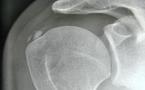 Les calcifications de l’épaule