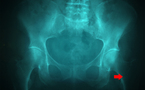 Débuter en écho-anatomie de hanche (hors nourrisson)