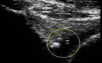 Chondromatose synoviale de hanche