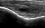 Fissuration Longitudinale du Tendon Commun des Epitrochléens