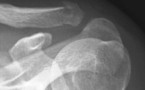 Traumatisme de l'extrémité distale de la clavicule