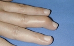 Mallet Finger