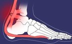 Cicatrisation du tendon calcanéen rompu