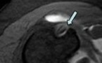 Rupture partielle du tendon du long biceps