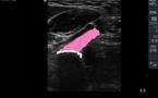 Approche médiale du tendon distal du biceps brachial