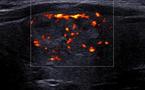 Lipome intramusculaire et Liposarcome bien différencié