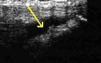 Ponction sous echoguidage d’une bursite pré-tibiale